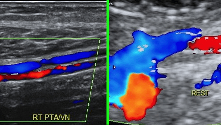 Color-Doppler
