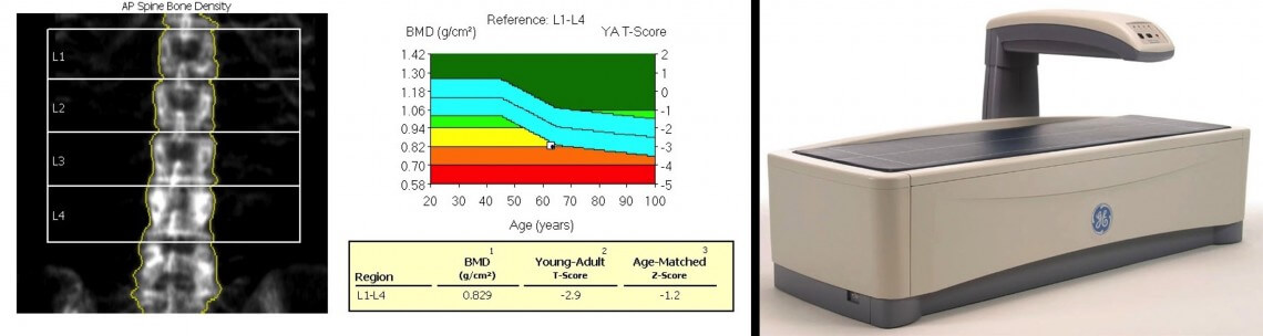 bone-densitometry