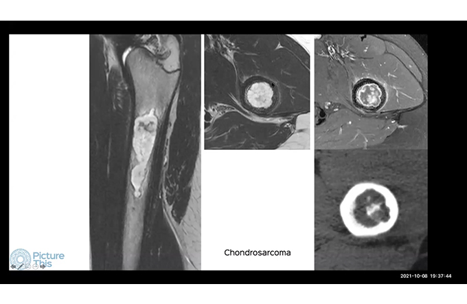 Bone Tumors