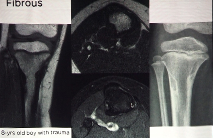Focal Bone Lesions Part II