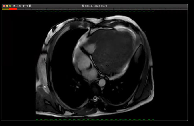 One case of cardiac MRI and one chest case