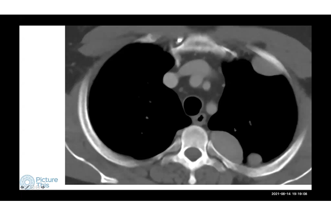 Chest Cases