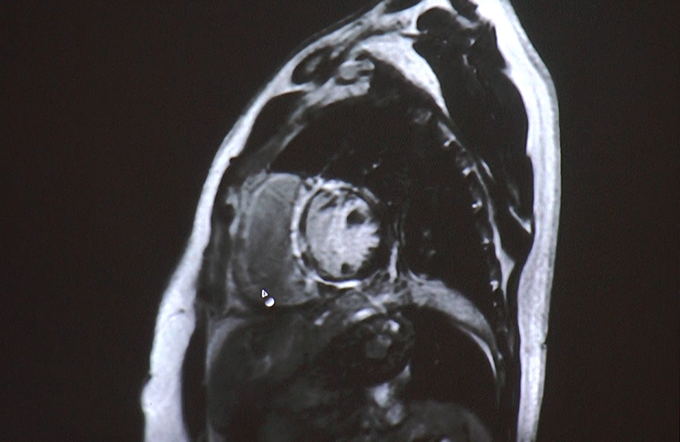 Case Discussion: Non- Ischemic Cardiomyopathies Part II