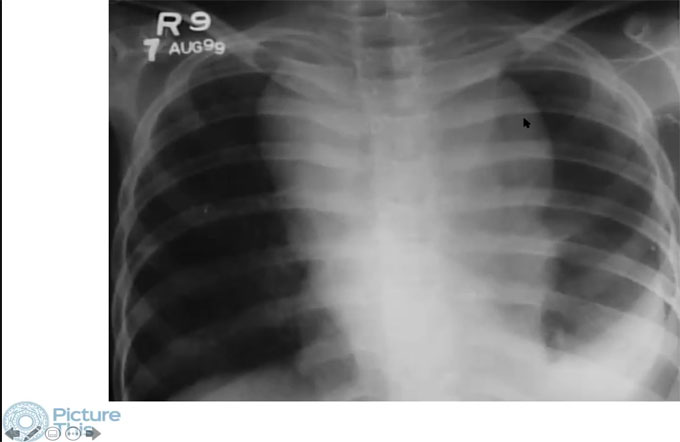 Chest Cases - Multiple with poll questions