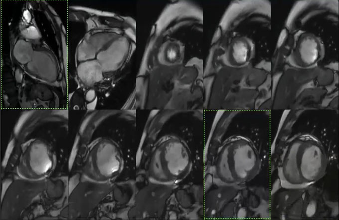 Cardiac MRI - understanding viability through cases - part II