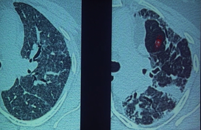 Approach To Interstitial Lung Disease Part - I