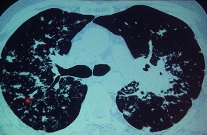 Approach To Interstitial Lung Disease Part - II