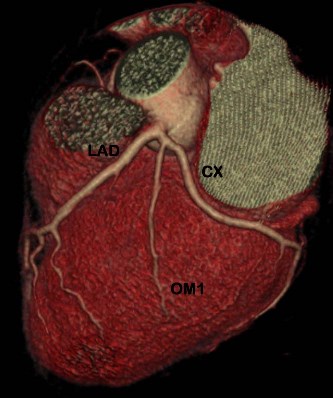 Cardiac-CT1