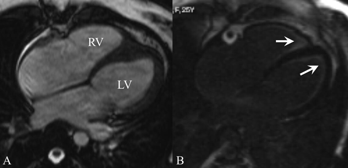 Cardiac-MRI