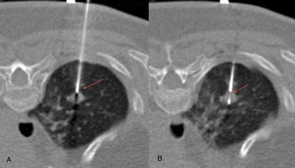 Ct-guided-biopsies