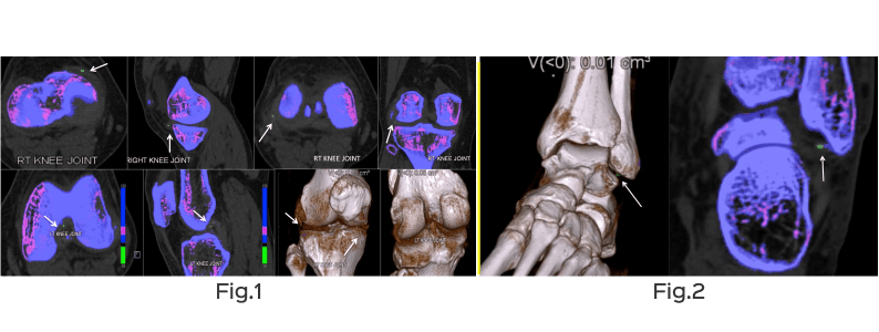 Gout-ct