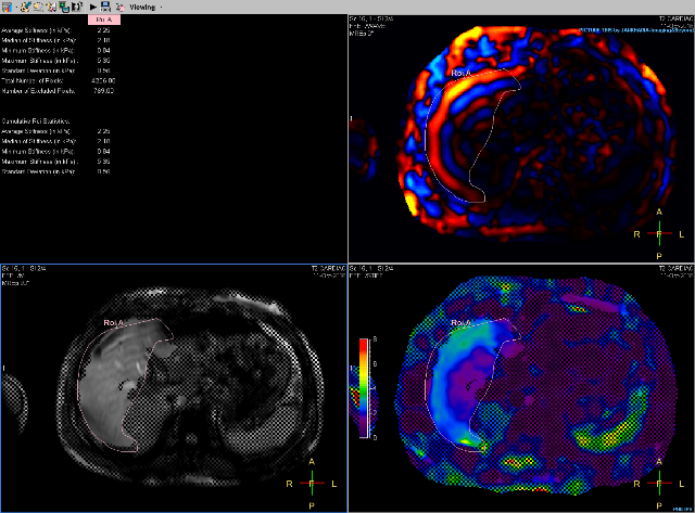MR ELASTOGRAPHY