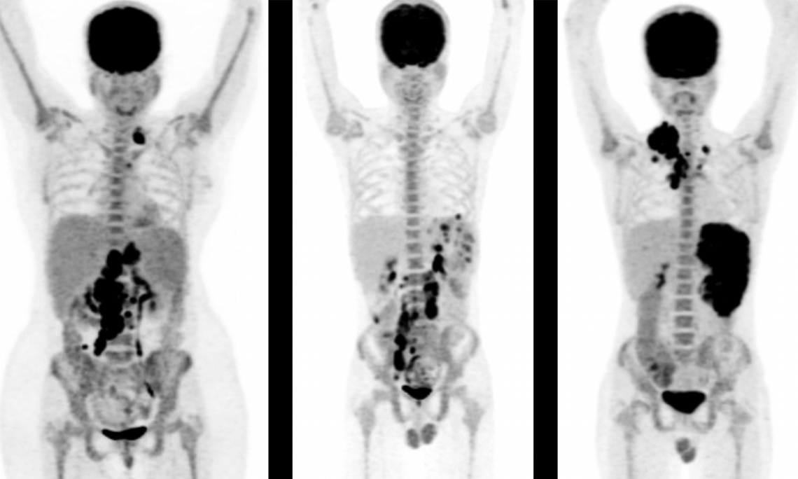 PET CT