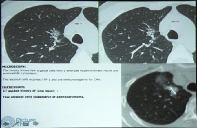 Classification and Approach to Subsolid Lung Nodules