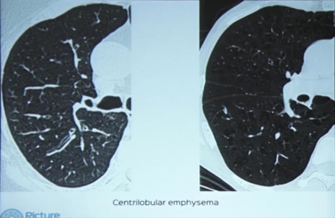 Case Based Discussion on Bronchiectasis, Emphysema and Airway Diseases - Part II