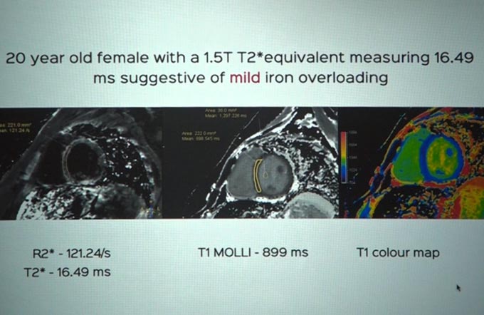 Cardiac MRI in Cardiomyopathies
