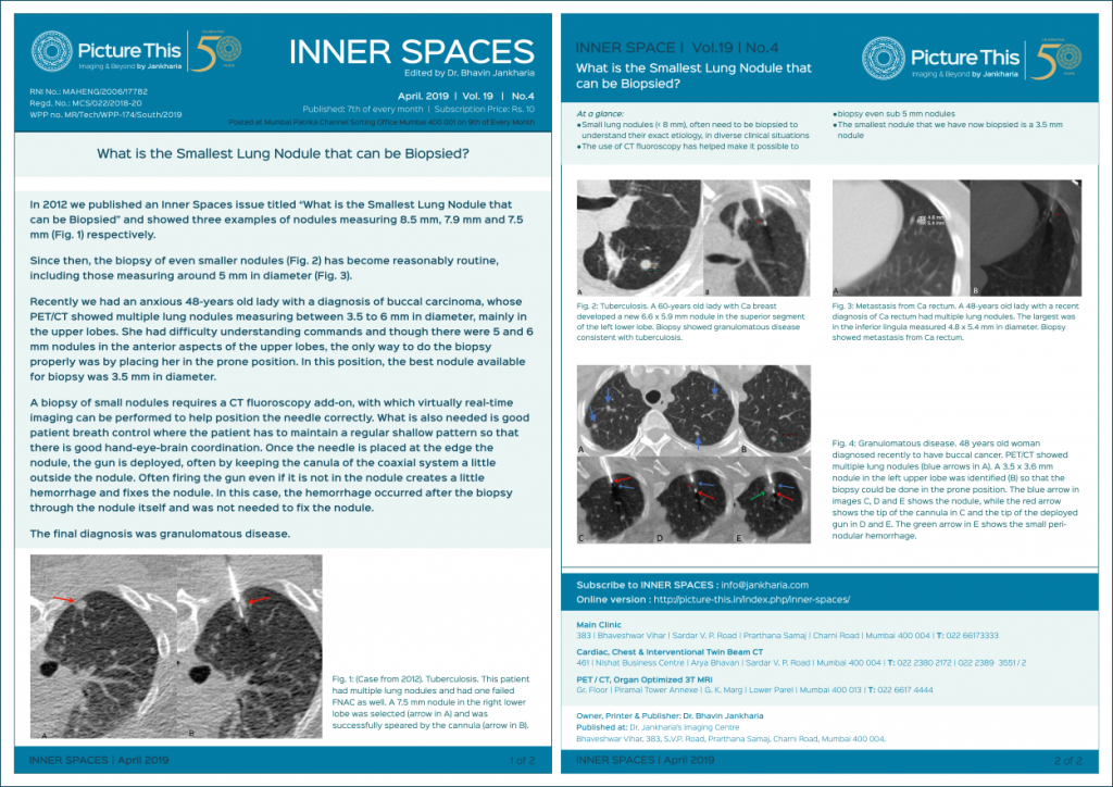 apr-is-what-is-the-smallest-lung-nodule-that-can-be-biopsied