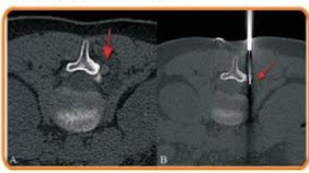 Radiofrequency Ablation of Spinal Osteoid Osteomas
