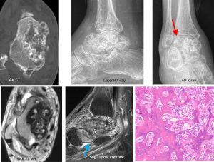 the-concept-of-benign-aggressive-bone-tumors-3