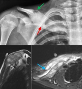the-concept-of-benign-aggressive-bone-tumors-6