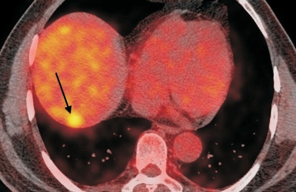 Radiofrequency Ablation of Solitary Liver Metastasis